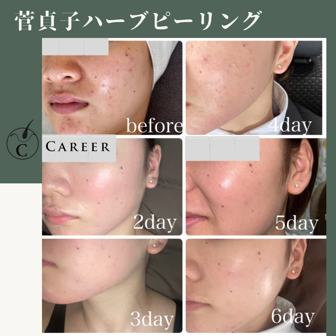 菅貞子ハーブピーリング認定講師です。｜エステ•スカルプ講師