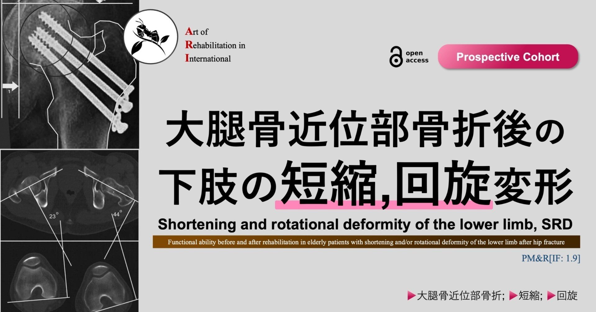 大腿骨近位部骨折後の下肢の短縮・回旋変形｜Super Human | 理学