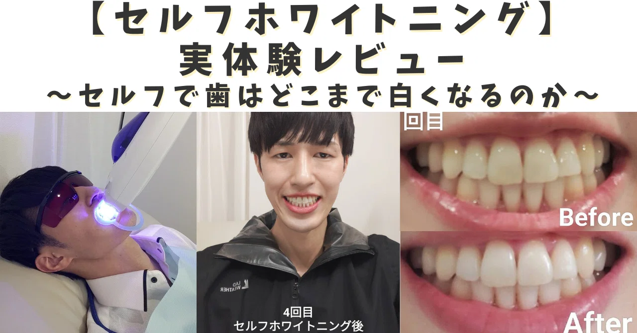 有料級》【セルフホワイトニング】実体験レビュー どこまで歯は白く
