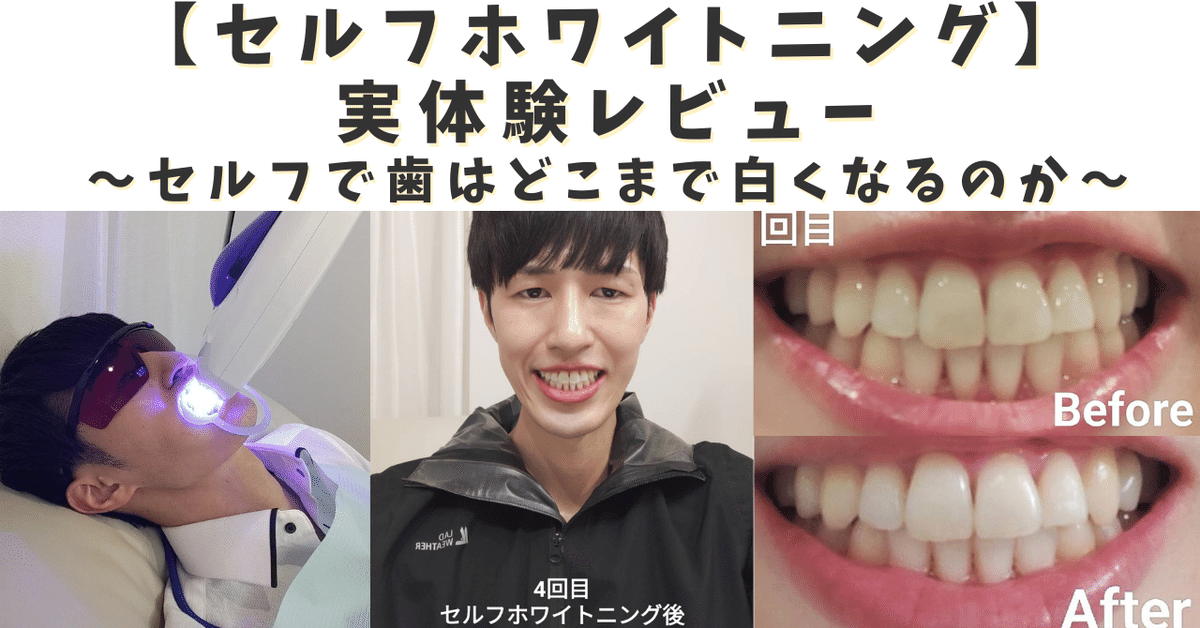 有料級》【セルフホワイトニング】実体験レビュー どこまで歯は