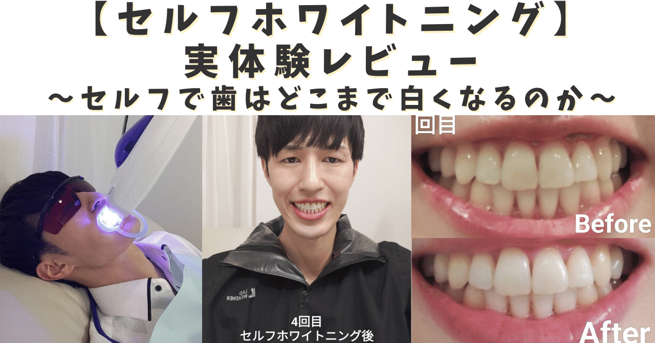 歯のセルフホワイトニング 有料級》【セルフホワイトニング】実体験レビュー どこまで歯は白く