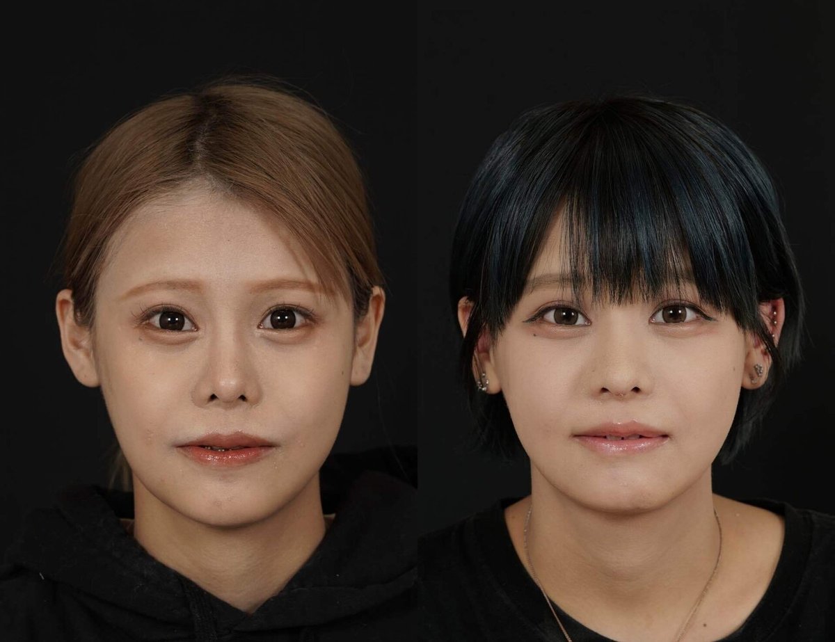 他院輪郭3点からの両顎手術の流れ｜骨切りドクター宮崎 