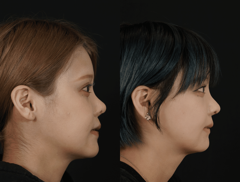 輪郭整形、両顎手術の症例写真