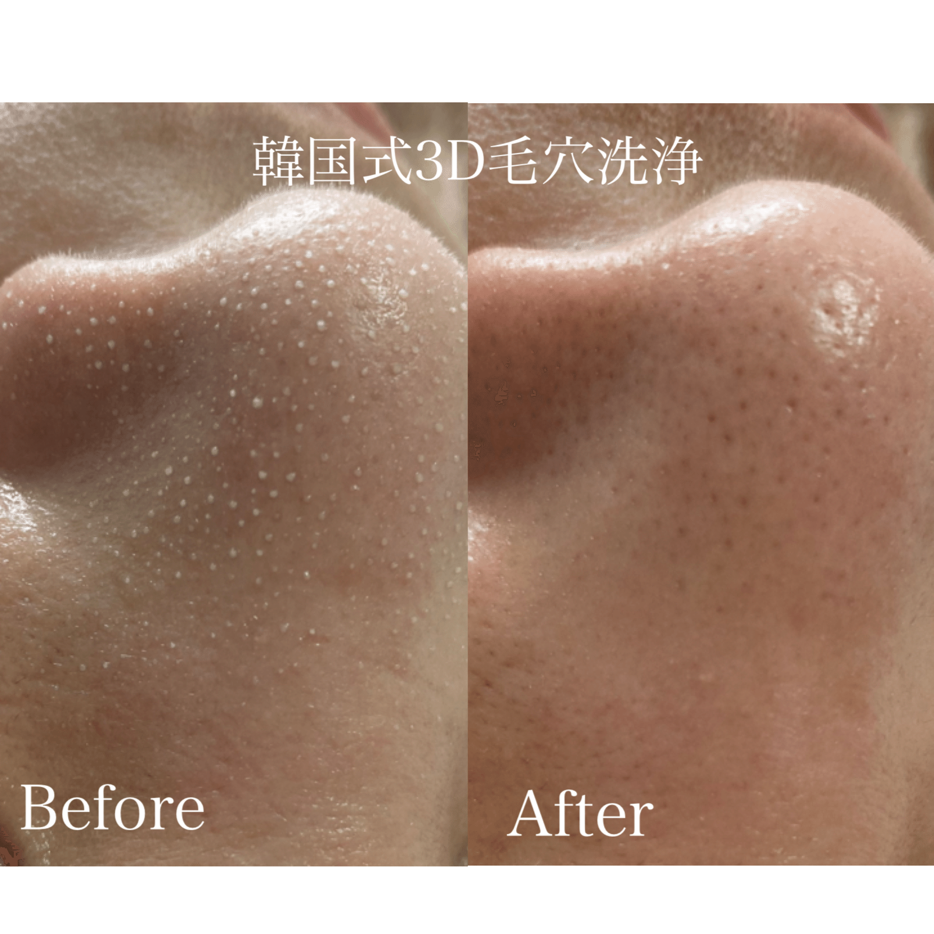 韓国式3D毛穴洗浄☆HARIKANジェル