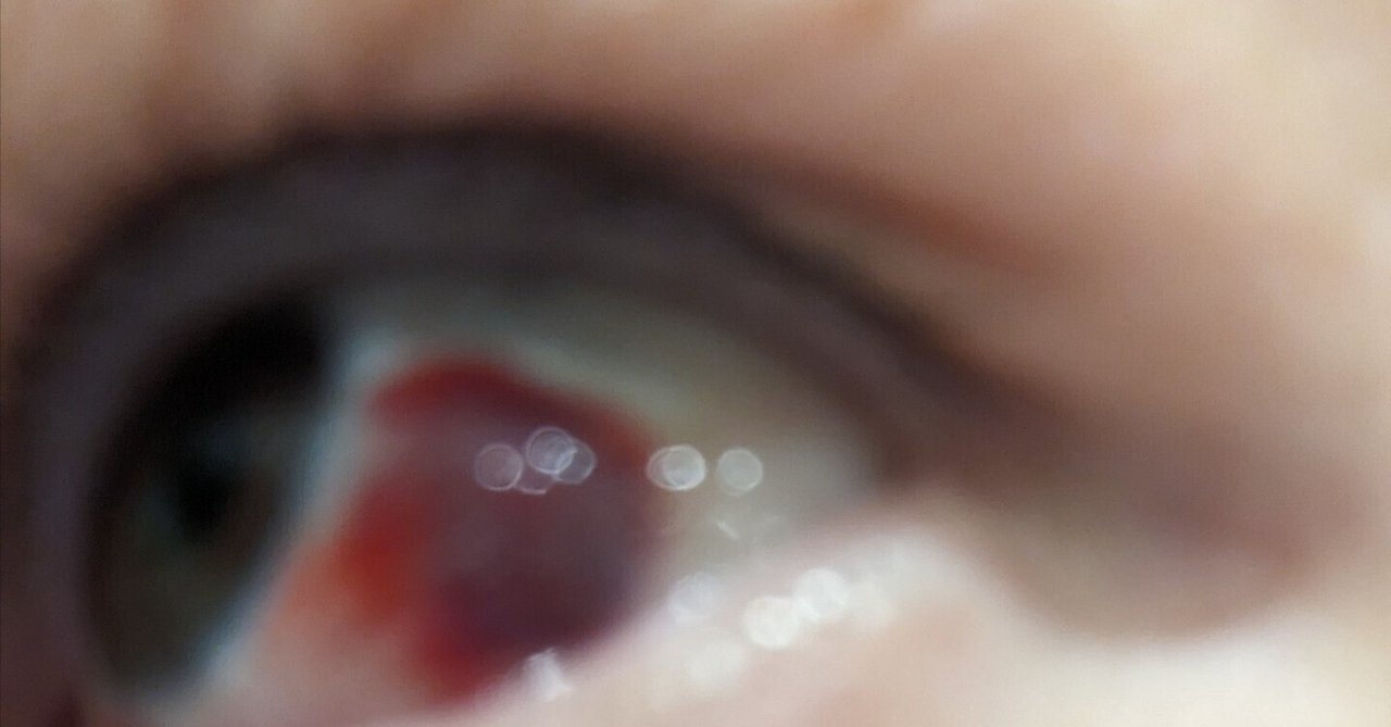 目が痛い話｜n