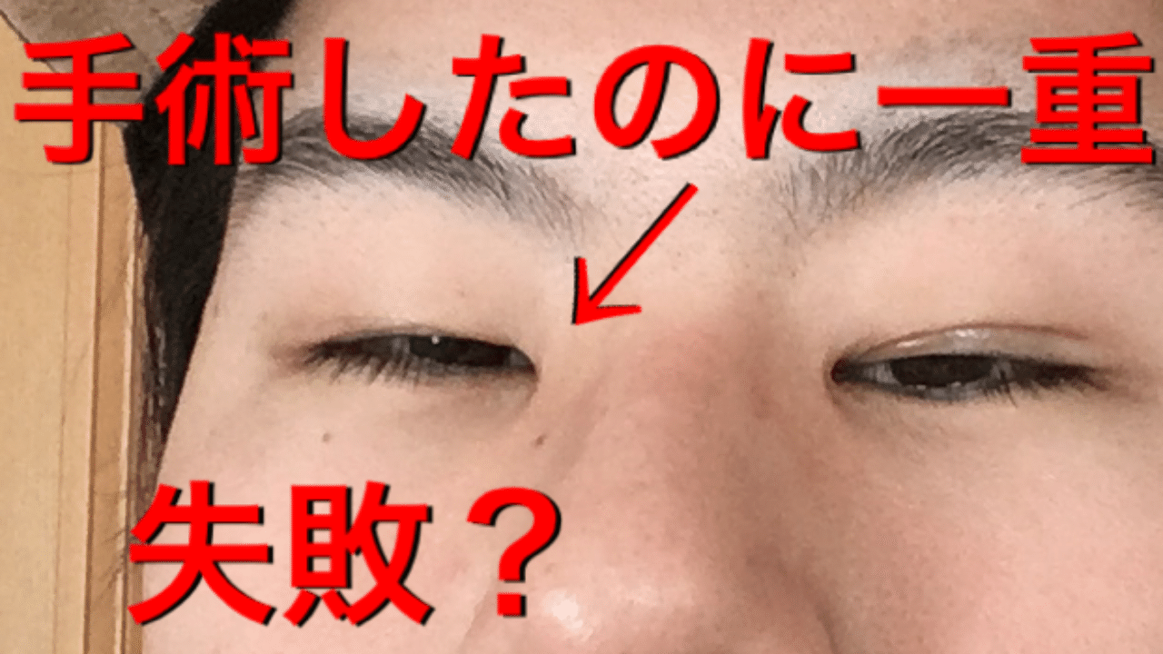 切開したのに一重に戻った 眼瞼下垂手術後4ヶ月 アサキユメミ Note 切開したのに一重に戻った 眼瞼下垂手術後4ヶ月 アサキユメミ Note