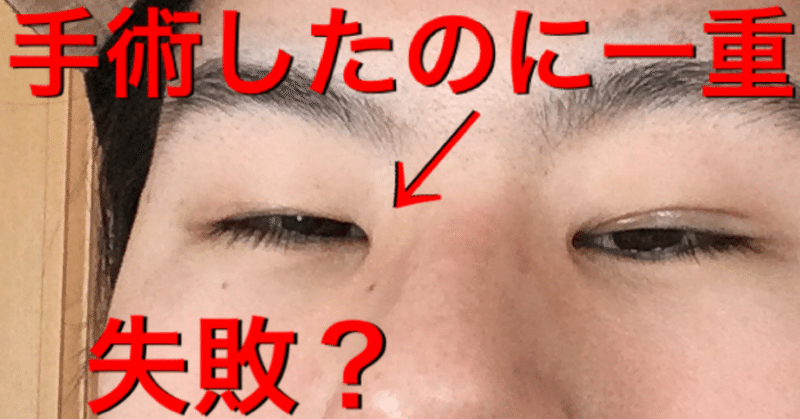 切開したのに一重に戻った 眼瞼下垂手術後4ヶ月 アサキユメミ Note