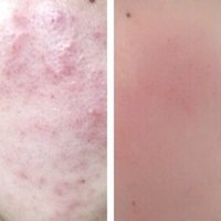 エンビロン挫折後 Mico 美肌のコツ Note