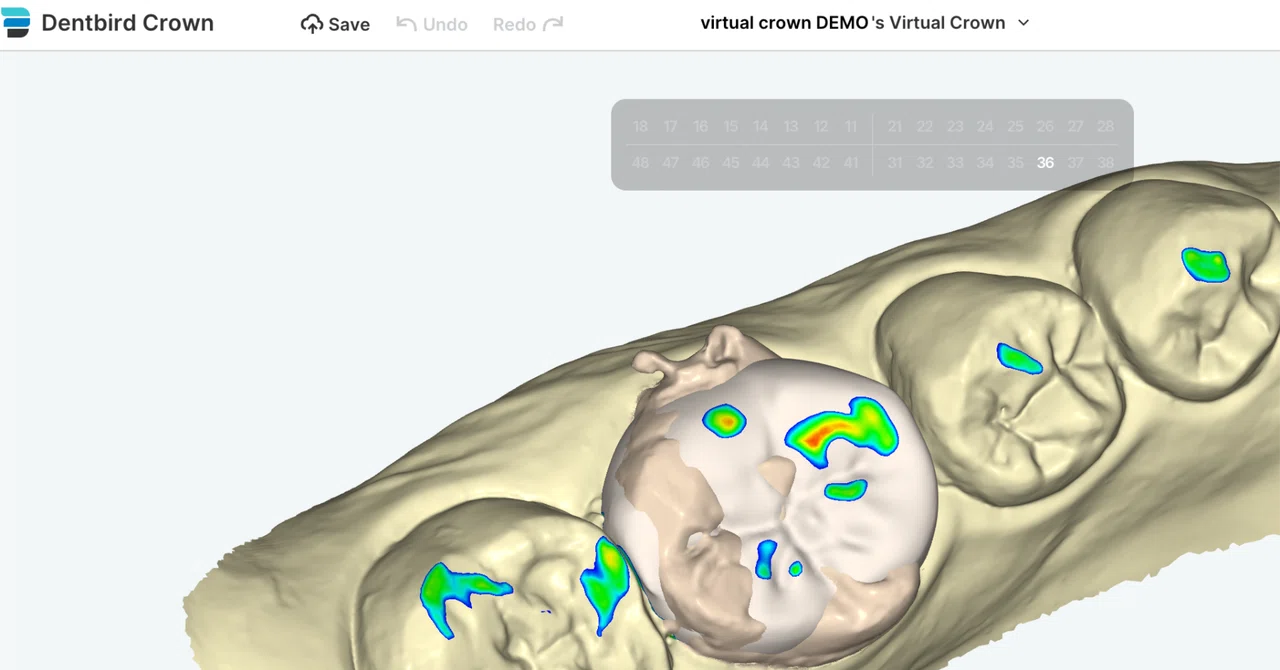 Dentbirdで自動ワックスアップ！（Virtual Crown機能の応用）ソフト使用料は現在無料！｜3D歯科