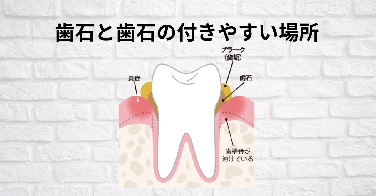 歯石と歯石の付きやすい場所｜いずみ中山歯科