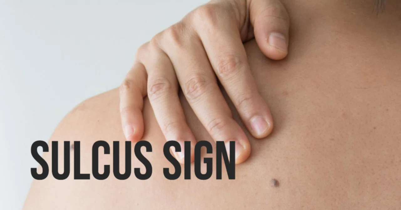 Sulcus Signb Sulcus Sign:肩関節下方不安定性の有無|PT Type B