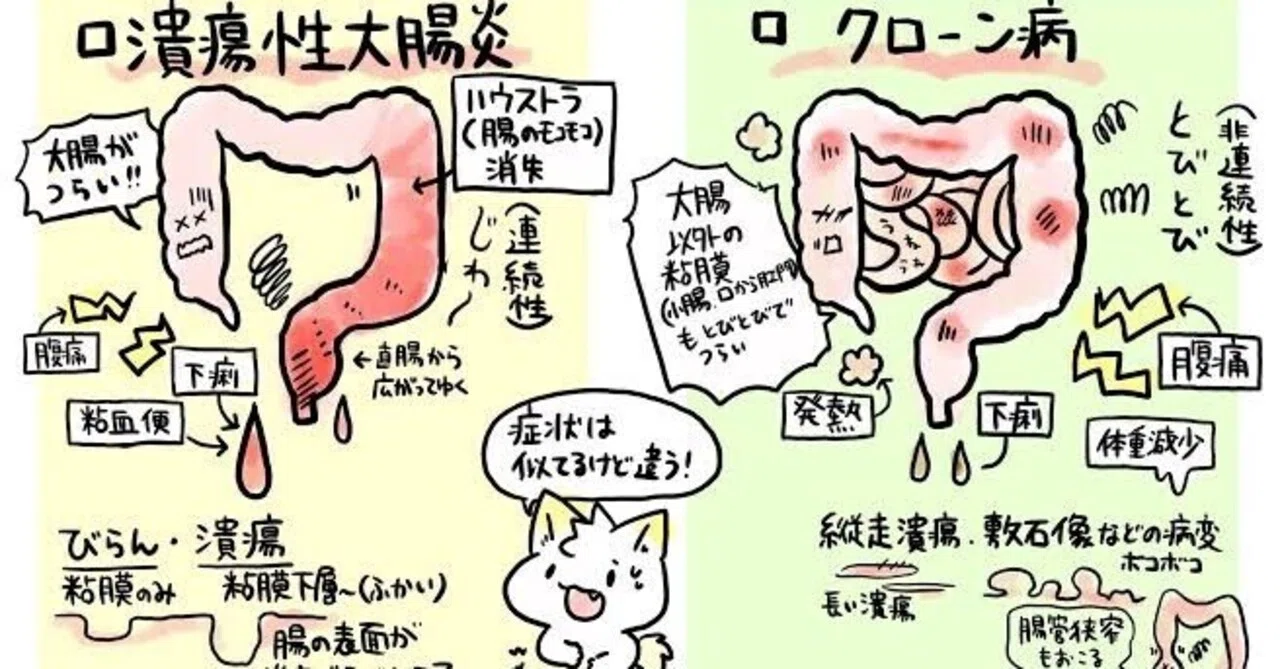 顕微鏡的大腸炎とは: 顕微鏡大腸炎 治療方法 – 膠原性大腸炎とは何ですか? – HOUJY