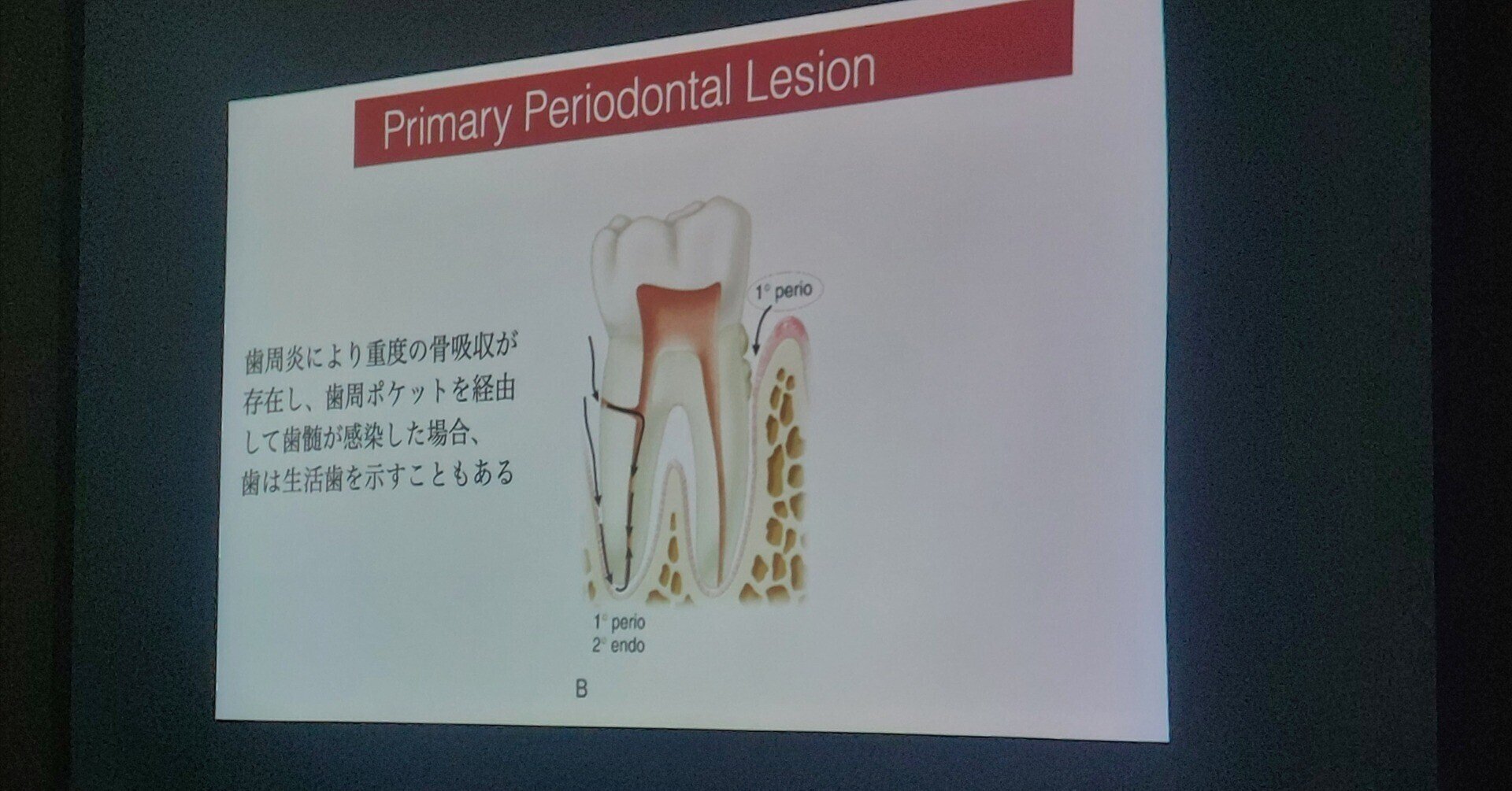 エンド・ペリオ病変の臨床歯内-歯周複合病変 診断と治療のストラテジー エンド・ペリオ病変の臨床 歯内－歯周複合病変 診断と治療の