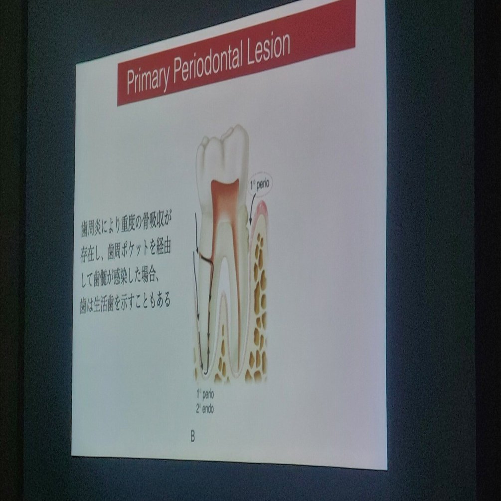エンドペリオ病変(歯内﹣歯周病変)の改訂｜二井 愛子(歯科衛生士)
