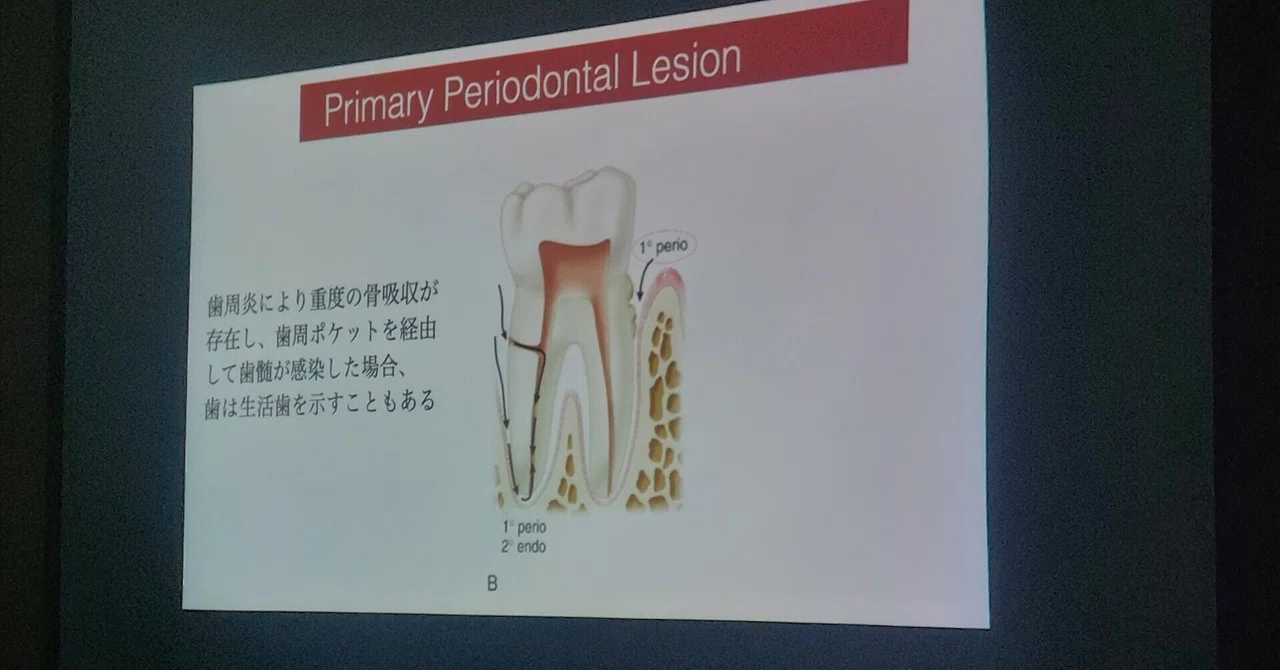 エンドペリオ病変(歯内﹣歯周病変)の改訂｜二井 愛子(歯科衛生士)