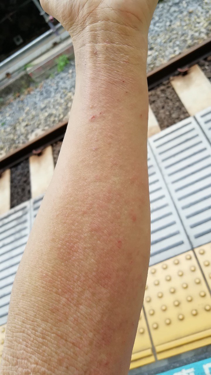 アトピー日記 7 1 両腕の現在 アトピーマン Note