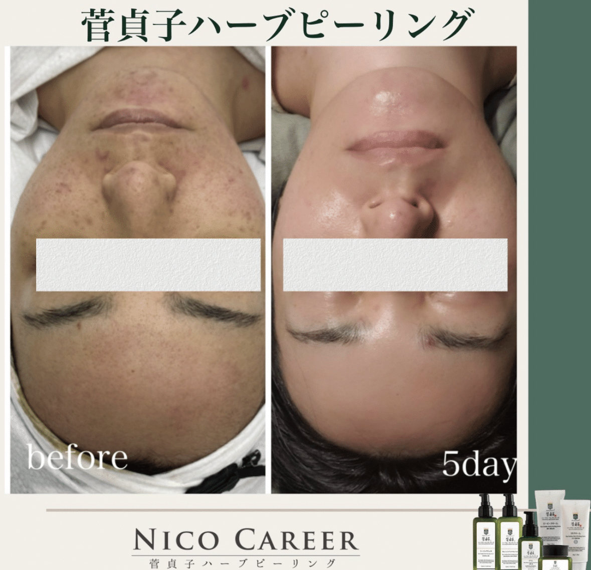 菅貞子 ハーブピーリング シリーズ 4種セット スキンケア KANコルギセラピー 1712131421.02.jpg