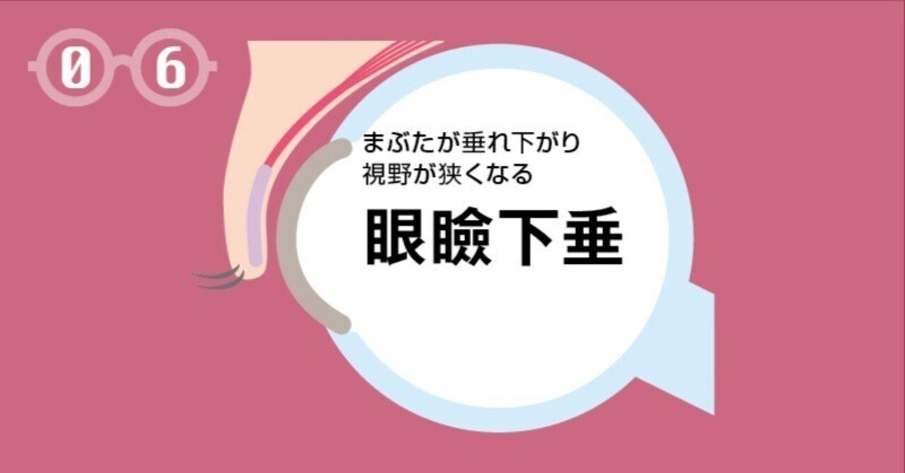 眼瞼下垂診療アップデート　柿﨑裕彦 眼瞼下垂診療アップデート柿﨑裕彦