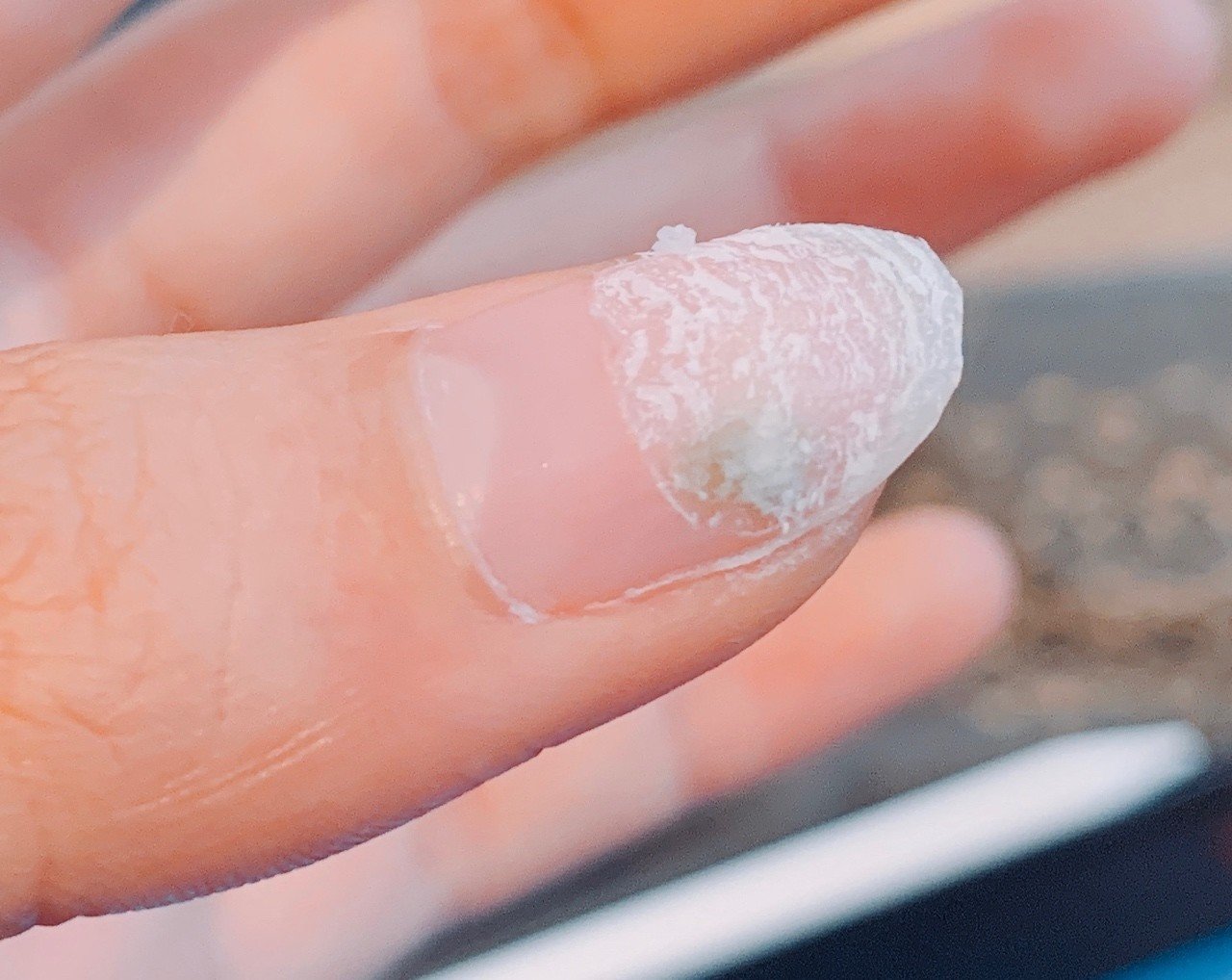 爪が腐った ジェルネイルが原因のグリーンネイルとは 現役美大生やみこ Note