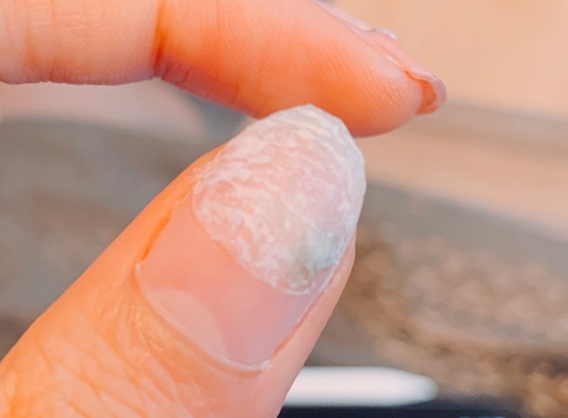 爪が腐った ジェルネイルが原因のグリーンネイルとは 現役美大生やみこ Note