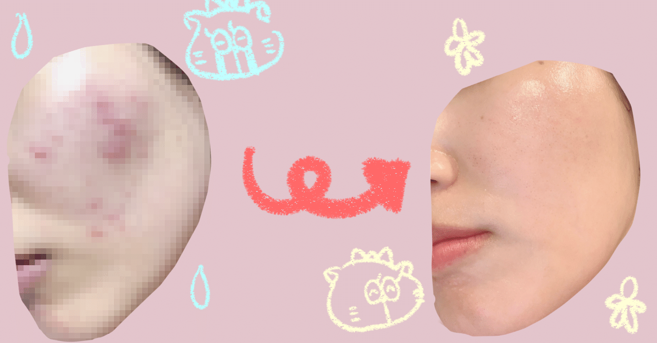 地獄のニキビ肌からツルツルお肌に生まれ変わったお話③（スキンケア