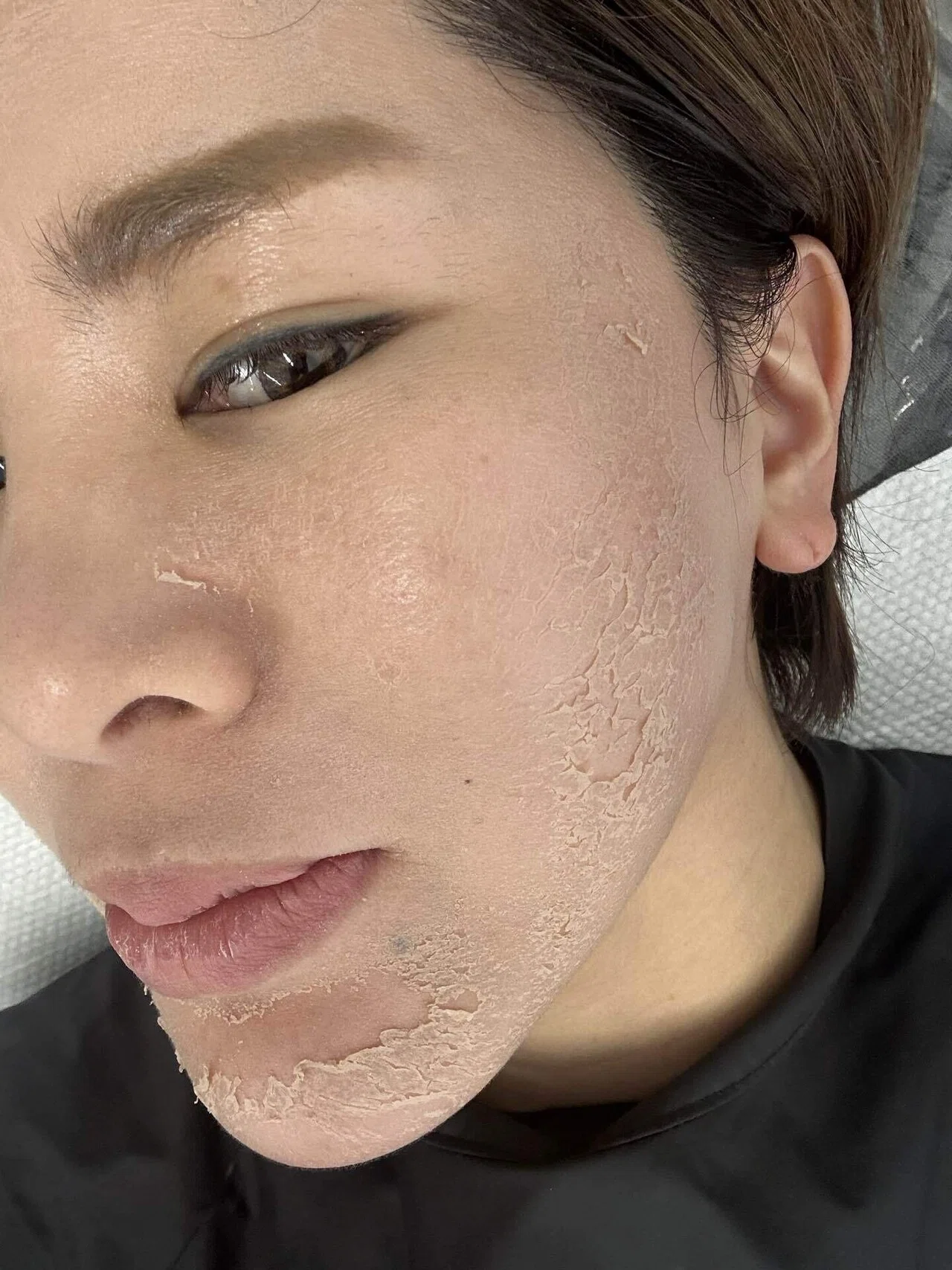 菅貞子ハーブピーリング剥離経過｜_career_beauty