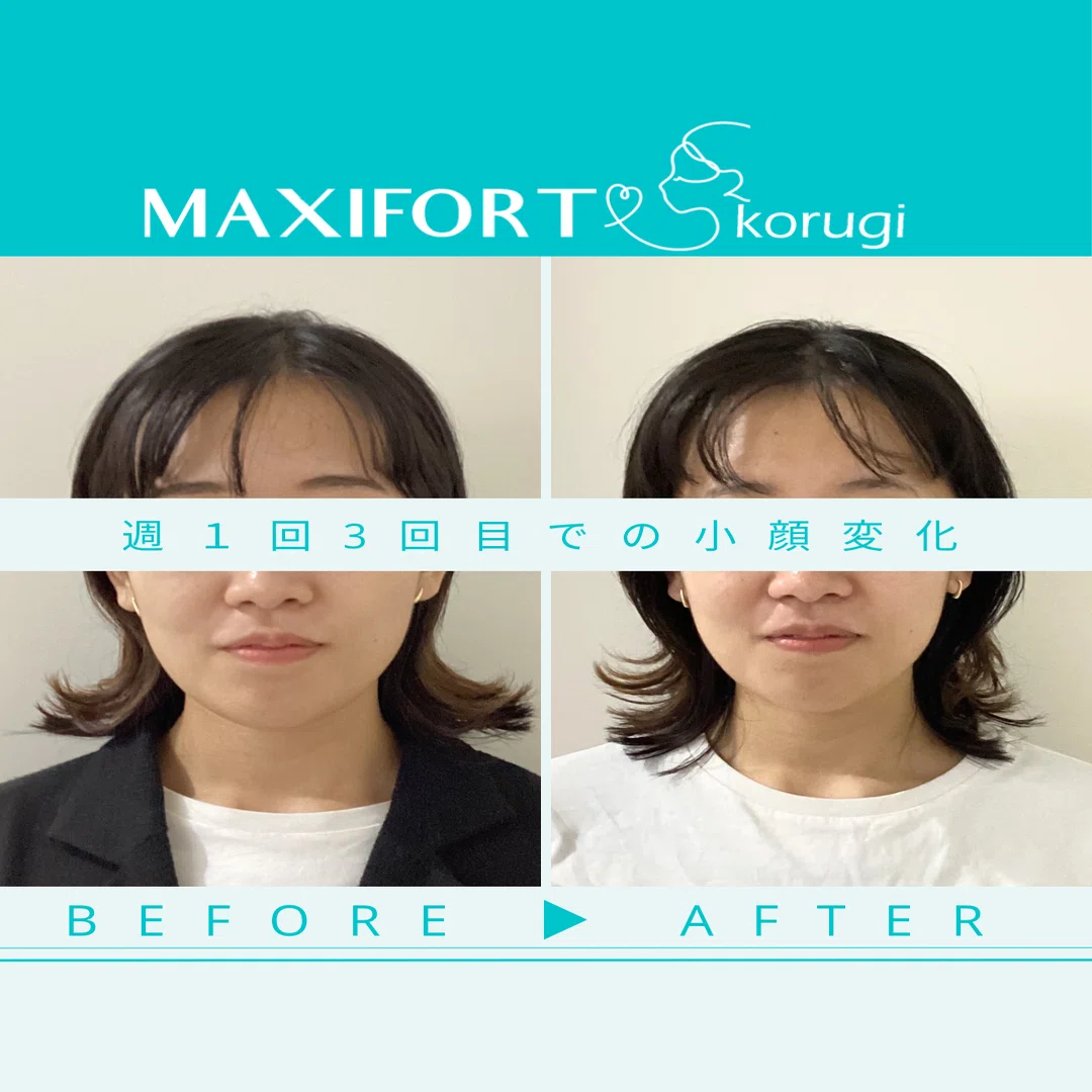 あご下の肉なくしたい人はみてね | 名古屋小顔サロン｜マイナス5キロ顔屋さん〈MAXIFORT〉