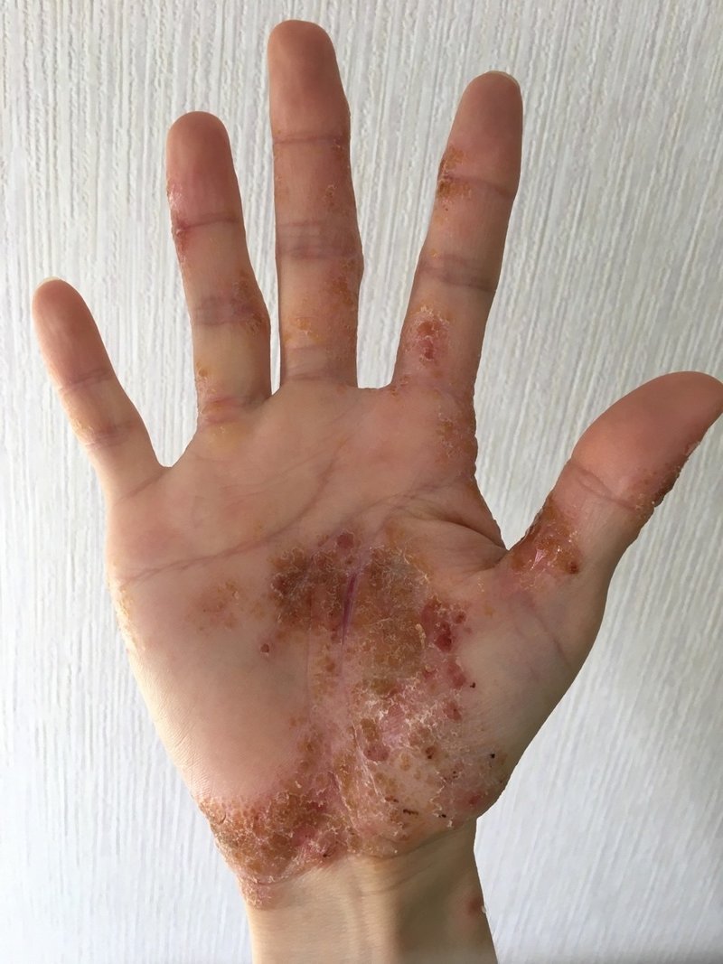 グロ画像注意 シャンプーが合わな過ぎて皮膚がぶっ壊れた時の話 チャルロ Note グロ画像注意 シャンプーが合わな過ぎて皮膚がぶっ壊れた時の話 チャルロ Note