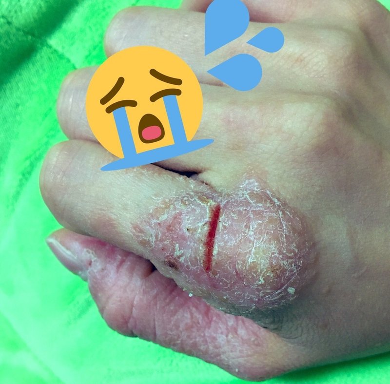 グロ画像注意 シャンプーが合わな過ぎて皮膚がぶっ壊れた時の話 チャルロ Note グロ画像注意 シャンプーが合わな過ぎて皮膚がぶっ壊れた時の話 チャルロ Note
