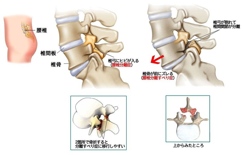 脊椎分離症と二分脊椎症の違い｜薬備（ヤクビ）〜保険薬局薬剤師のアカデミック備忘録〜鎌田貴志｜note