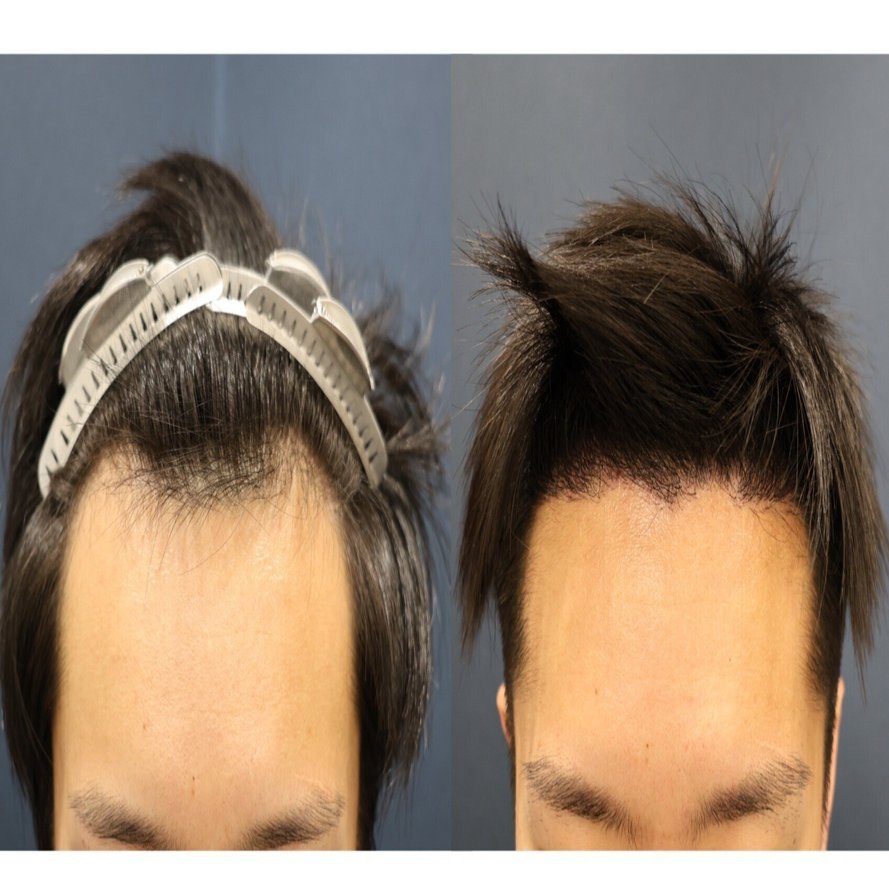 症例解説④】自毛植毛 アルモHi-STANDARD法 1700グラフト 生え際 術後3