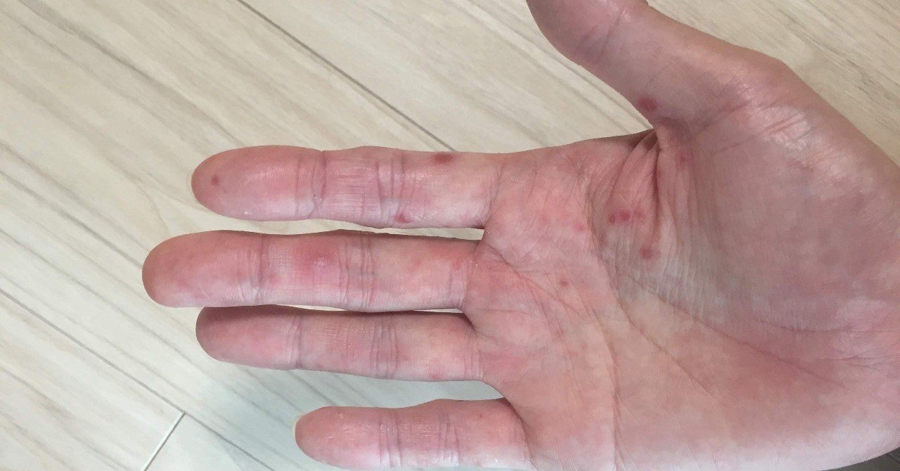 熱が下がったあとが本番だった 大人の手足口病 そのべゆういち Note