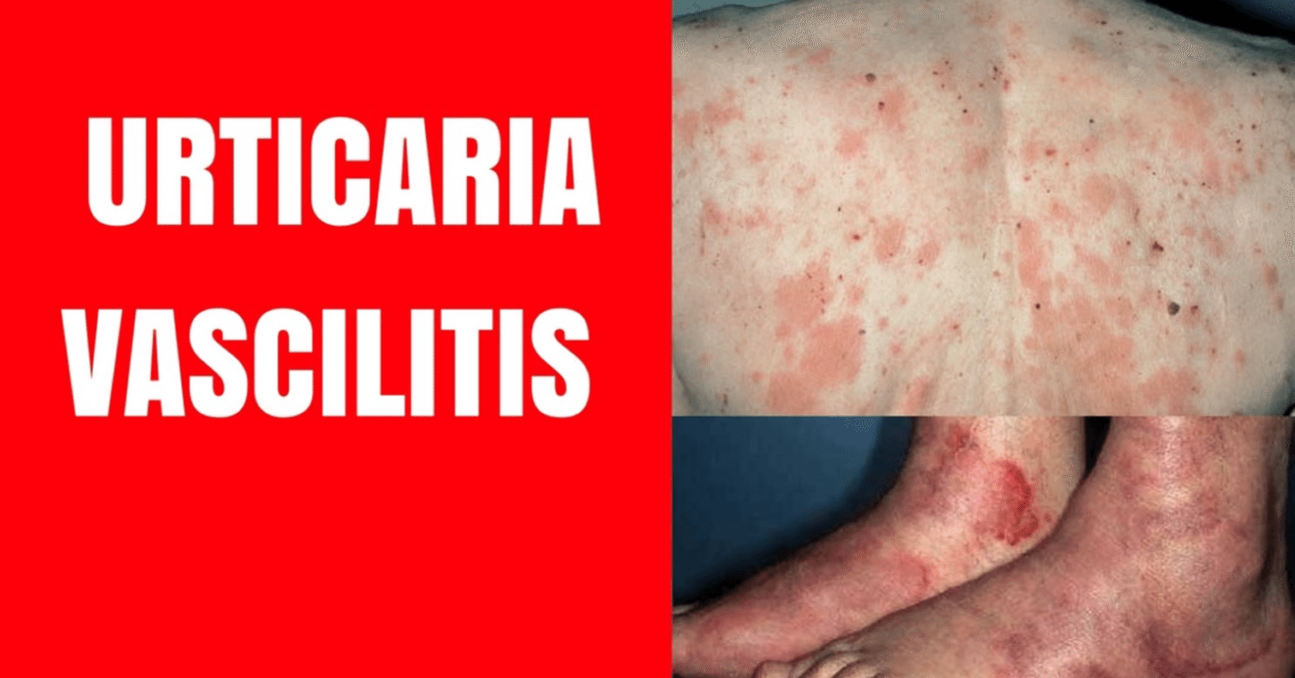 蕁麻疹様血管炎 Urticarial Vasculitis｜TAKENOUCHI M.D.