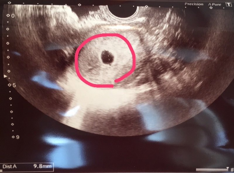 実録 妊娠検査薬陽性反応 胎嚢確認 妊婦体験ブログ 2 第4週3日 第5週3日 激励マダム まお Private Memo Note