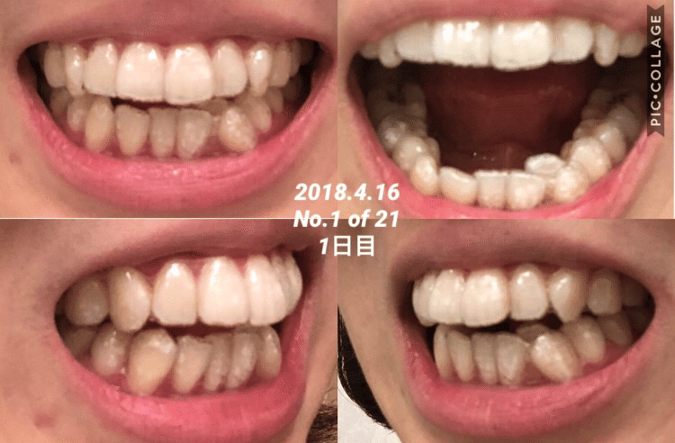 矯正1年以上経過 横顔も るったん Note