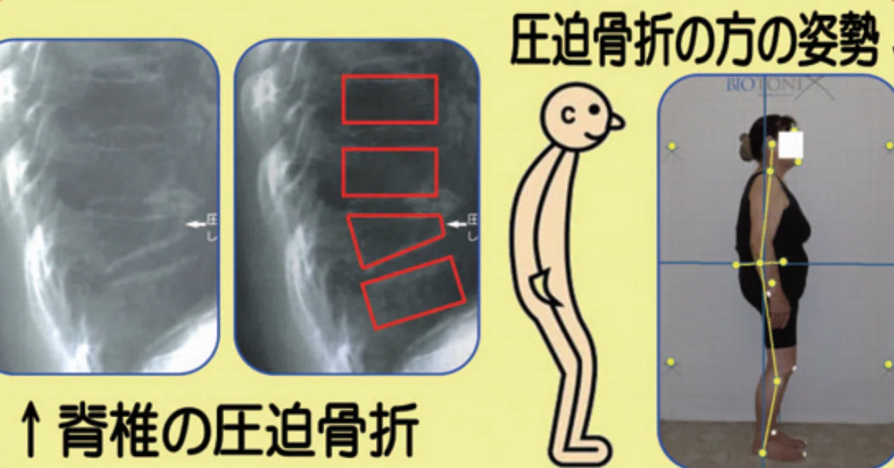 いつの間に か 骨折