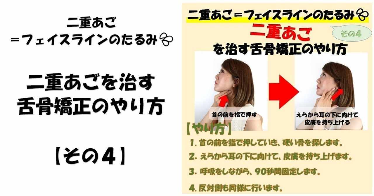 フェイスラインを持ち上げて二重あごを治す 舌骨矯正のやり方 その4 Revisionginza Note