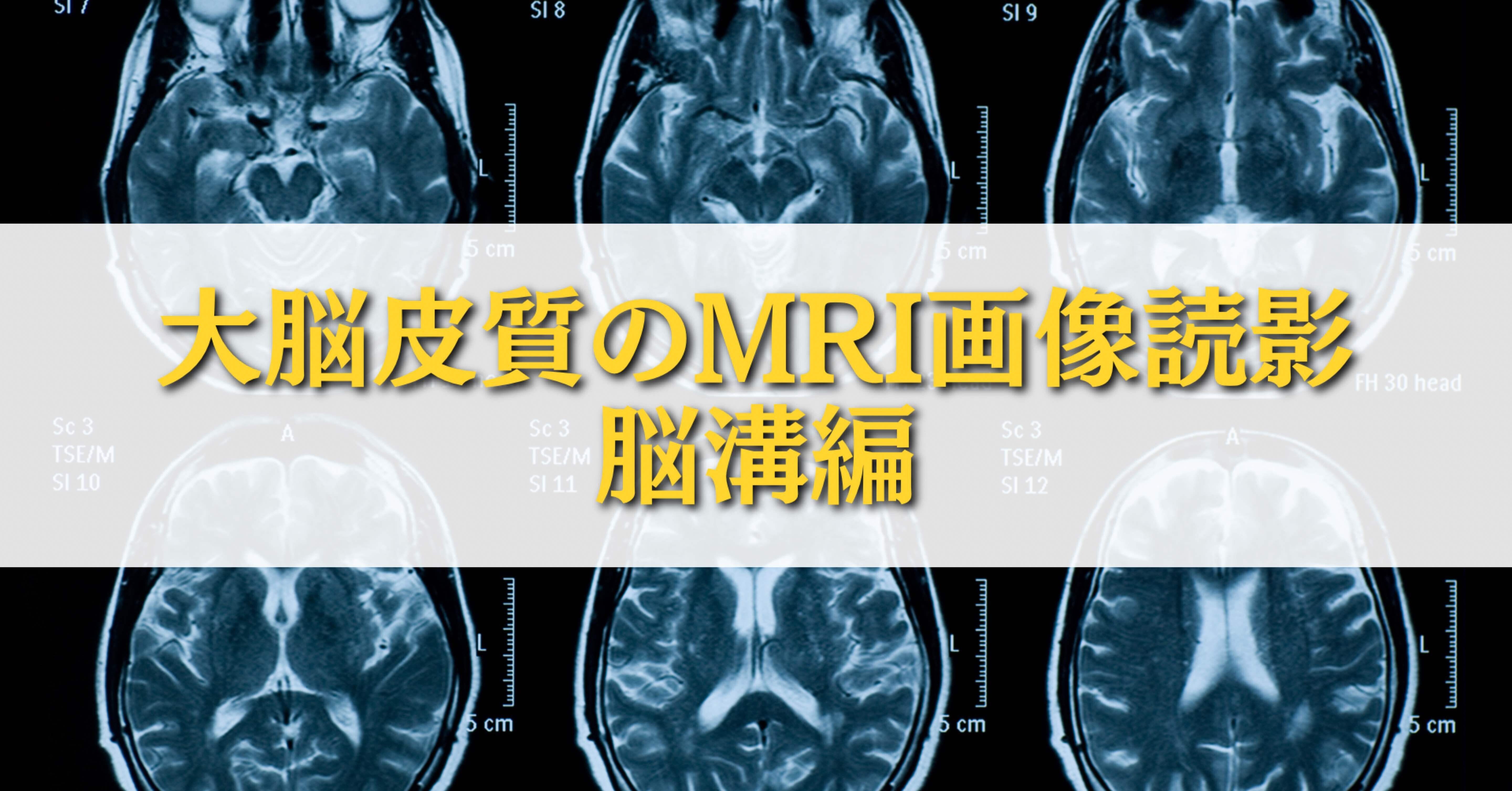 大脳皮質のMRI画像読影-脳溝編-｜サギョウ先生