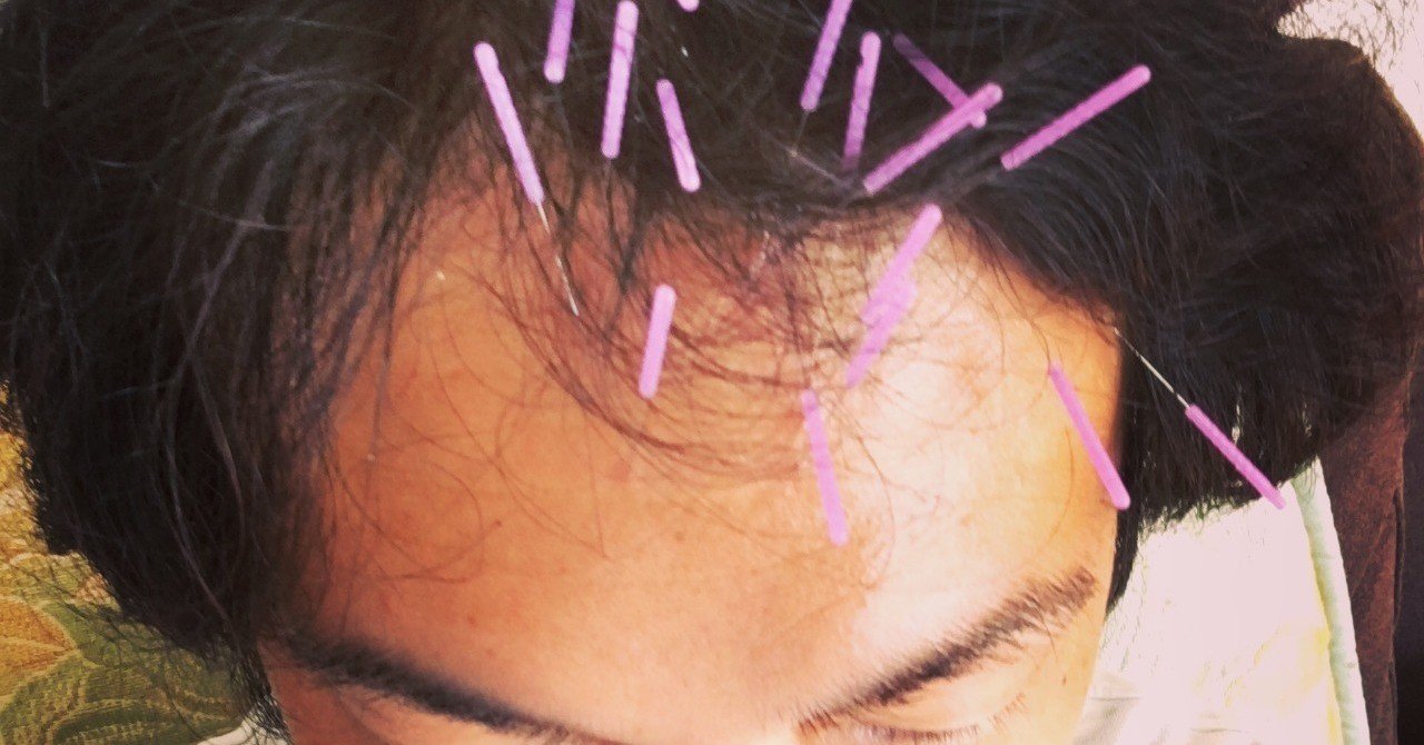 YNSA（山元式新頭鍼療法）を体験してみた話｜戸田 修輔Shusuke Toda