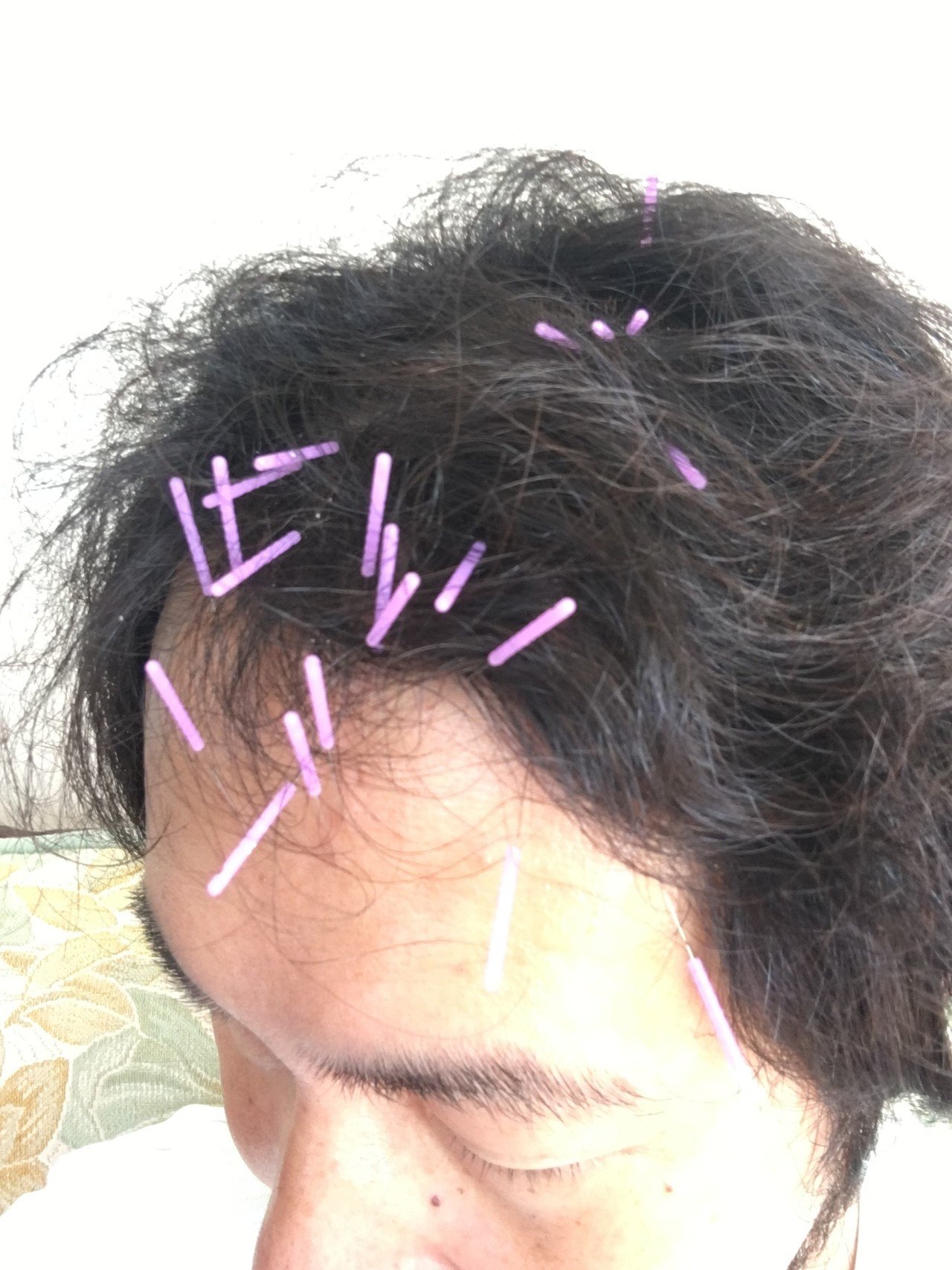 YNSA（山元式新頭鍼療法）を体験してみた話｜戸田 修輔Shusuke Toda