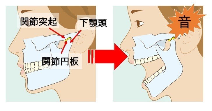 アゴがポキポキ鳴る時の下アゴの牽引矯正法のやり方 Revisionginza Note