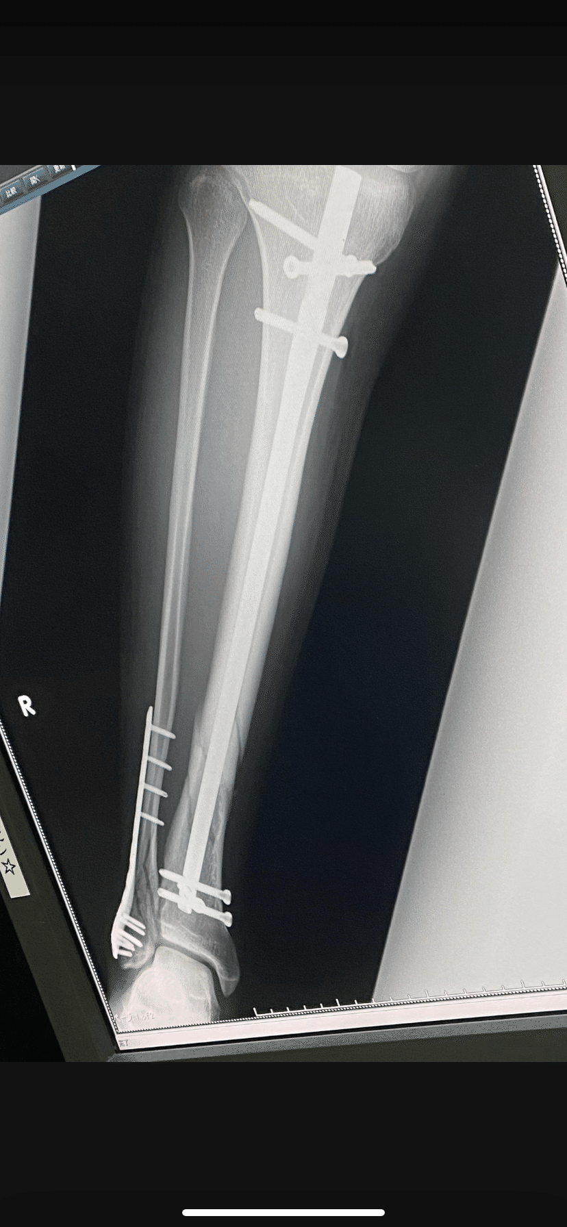 髄内釘抜釘しました。（入院から手術まで｜ゆーた