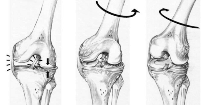 20240506BB: 膝ACL損傷・骨挫傷・MRI