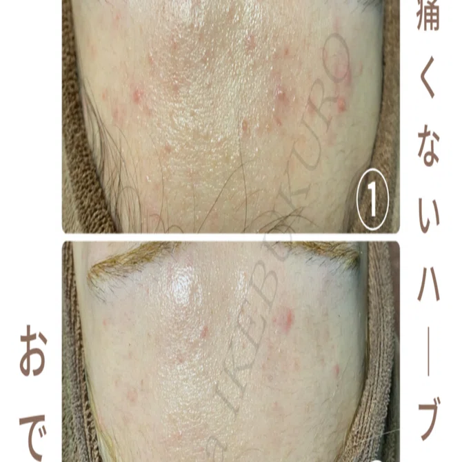 みちこ　ハーブピーリング　１０回分 おでこのハーブピーリング】初回〜3回目までの変化｜肌改善＆ハーブ