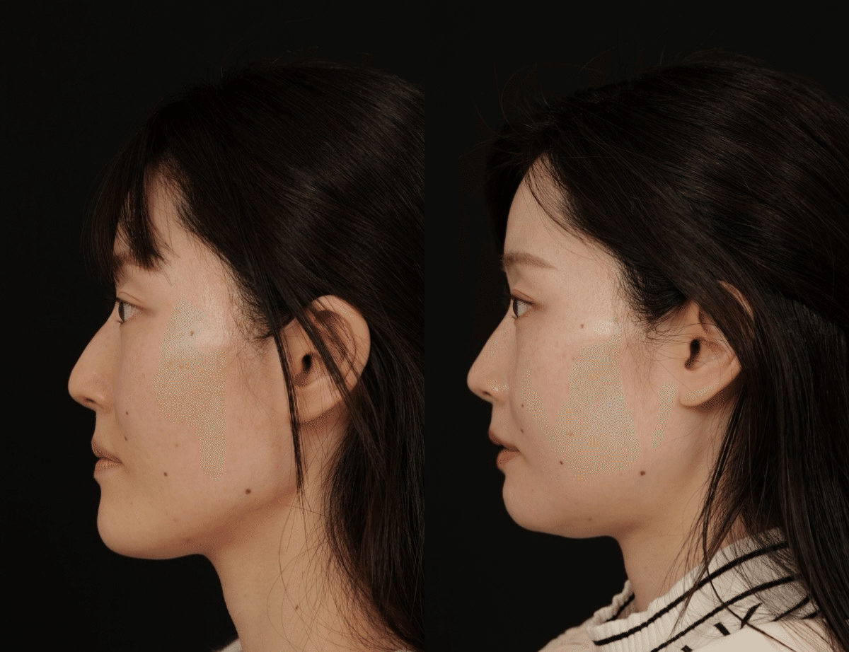 両顎手術、術後1ヵ月の経過写真です