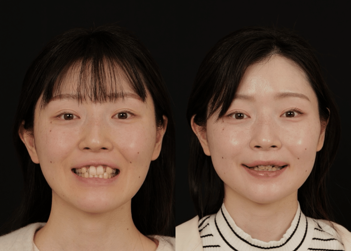 両顎手術、術後1ヵ月の経過写真です