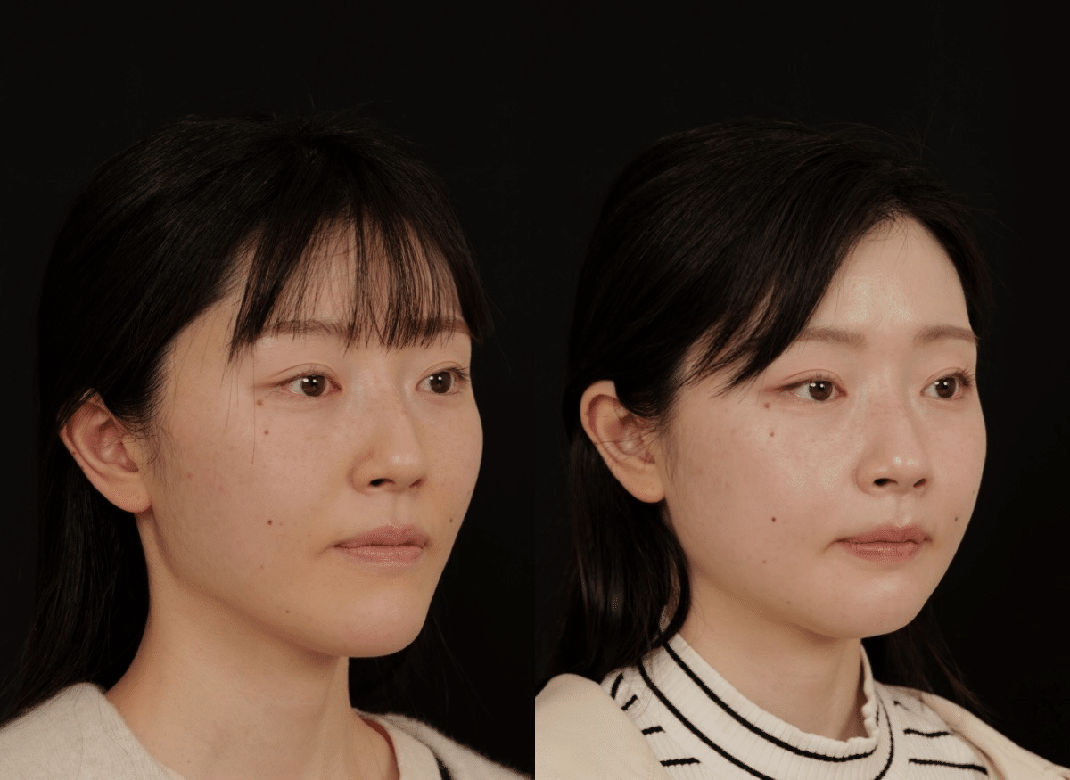 両顎手術術後1か月の経過写真です。