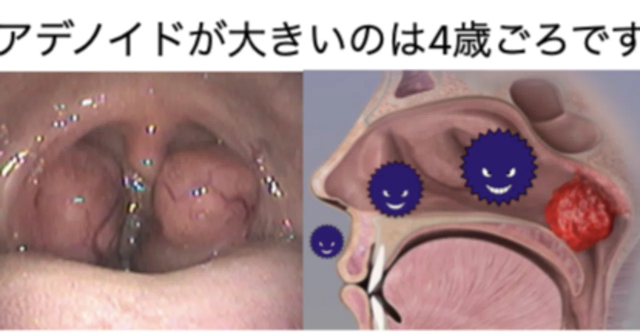 子供の扁桃腺とアデノイド、取る？取らない？｜耳鼻科医の情報発信