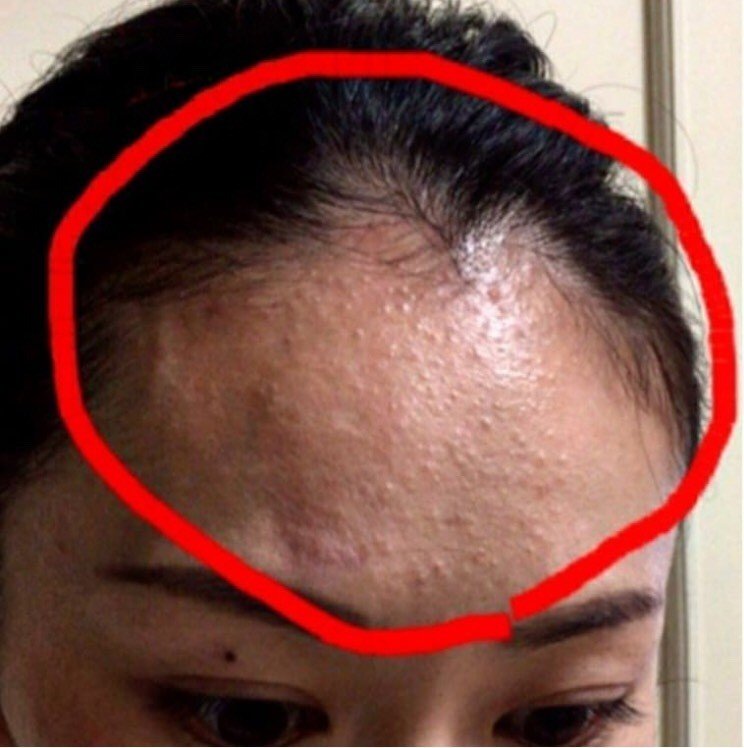エステサロン時代のショッキングな舞台裏3 ニキビ肌のころの写真アリ あおい Note エステサロン時代のショッキングな舞台裏3 ニキビ肌のころの写真アリ あおい Note