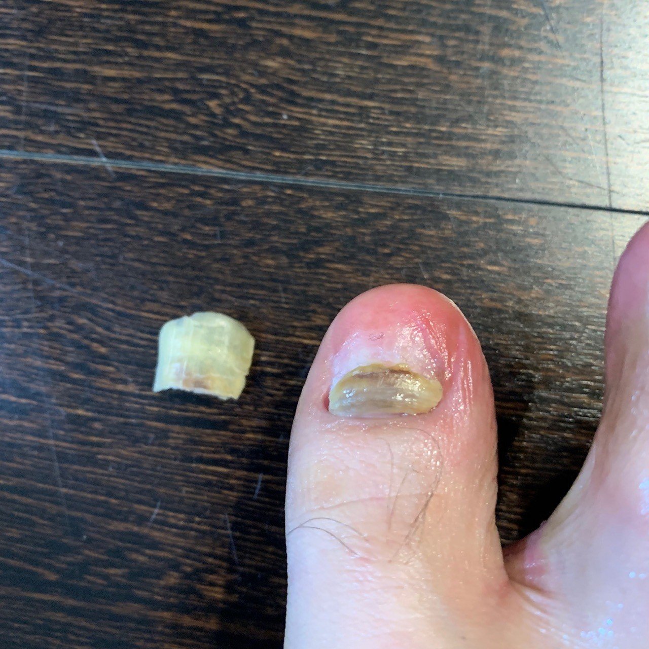 剥がれ 爪 た が 親指 の の 足 足をぶつけ親指の爪がほぼ剥がれてしまったので外科に行き麻酔をして爪を抜いて